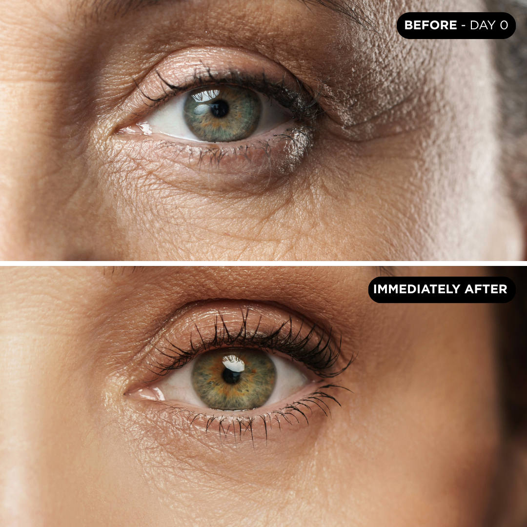 Antes y después parches para ojeras UNICSKIN